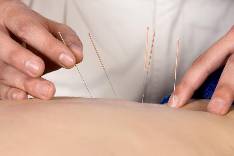 Acupuncture Cape Coral, FL